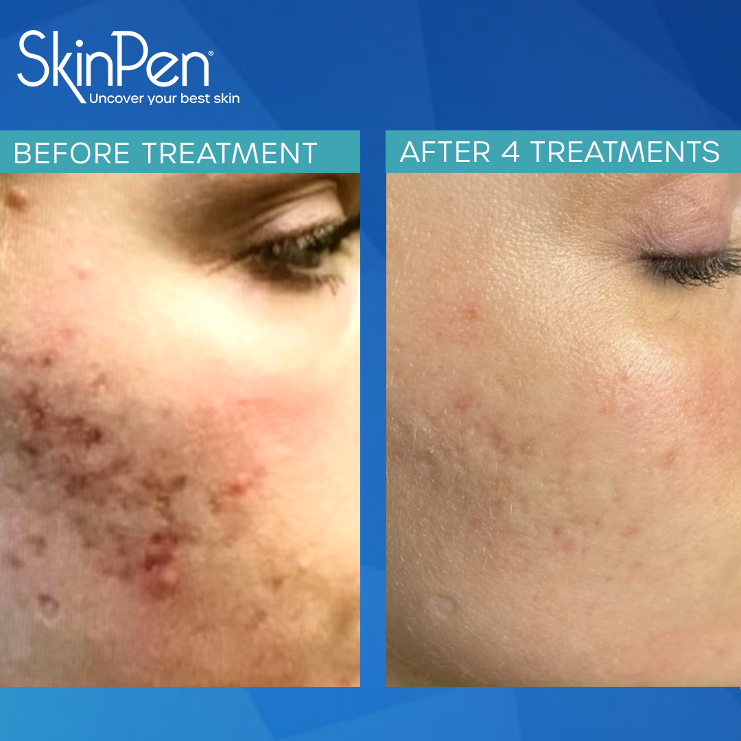 SkinPen® Precision Microneedling